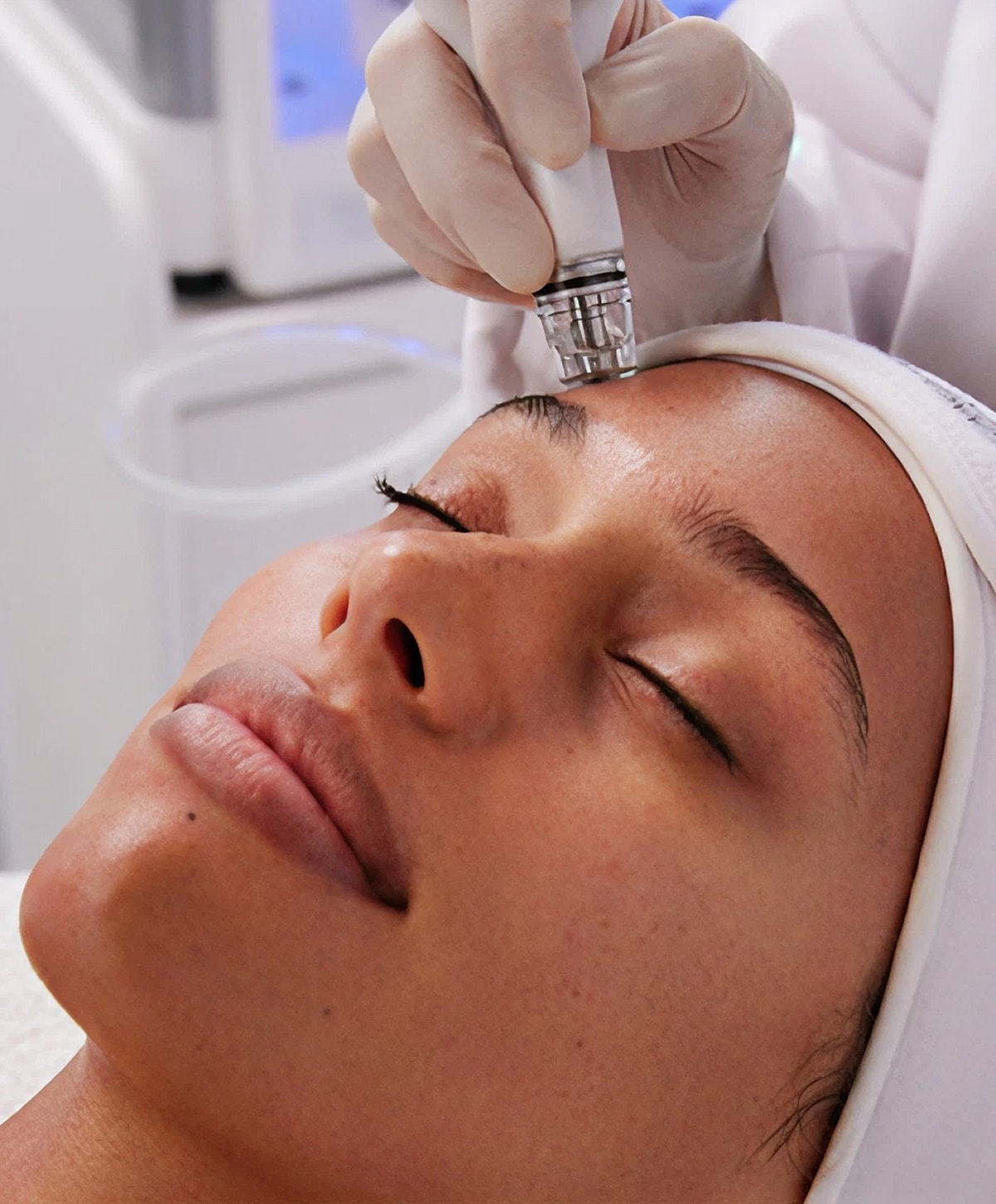 Facial treatment with a microneedling device.