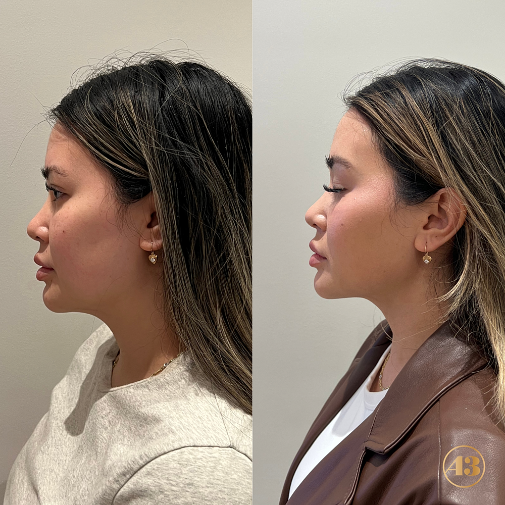 Morpheus8 Before & After