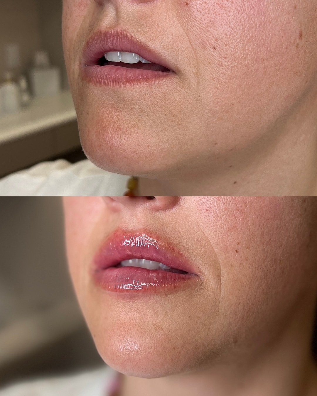 Lip Filler Before & After