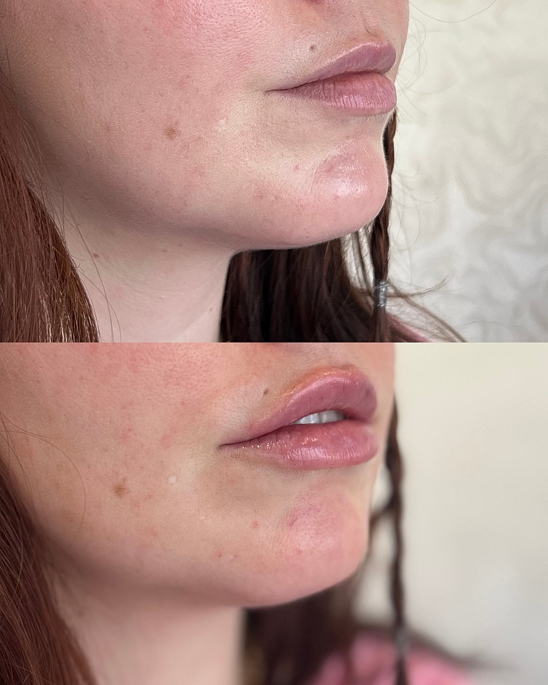 Lip Filler Before & After
