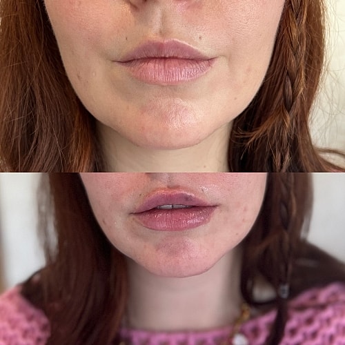 Lip Filler Before & After