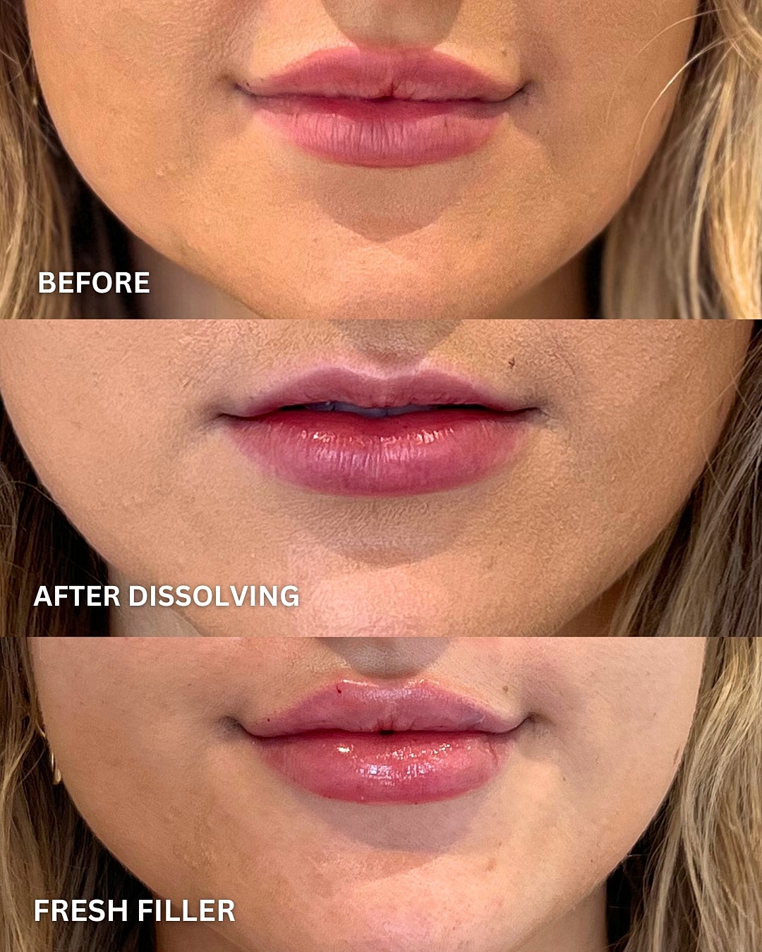 Lip Filler Before & After