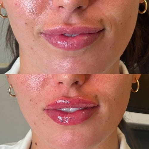 Lip Filler Before & After