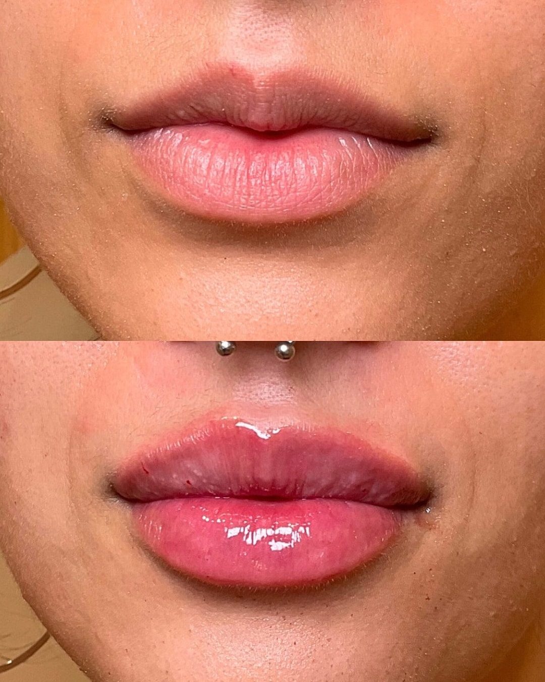 Lip Filler Before & After