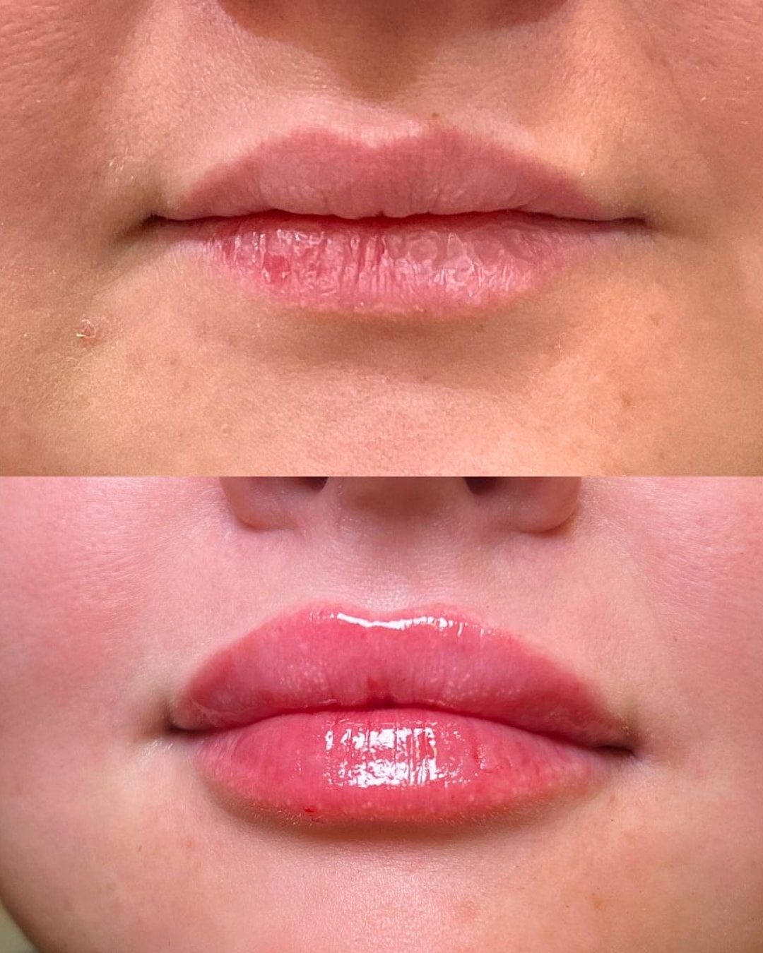 Lip Filler Before & After