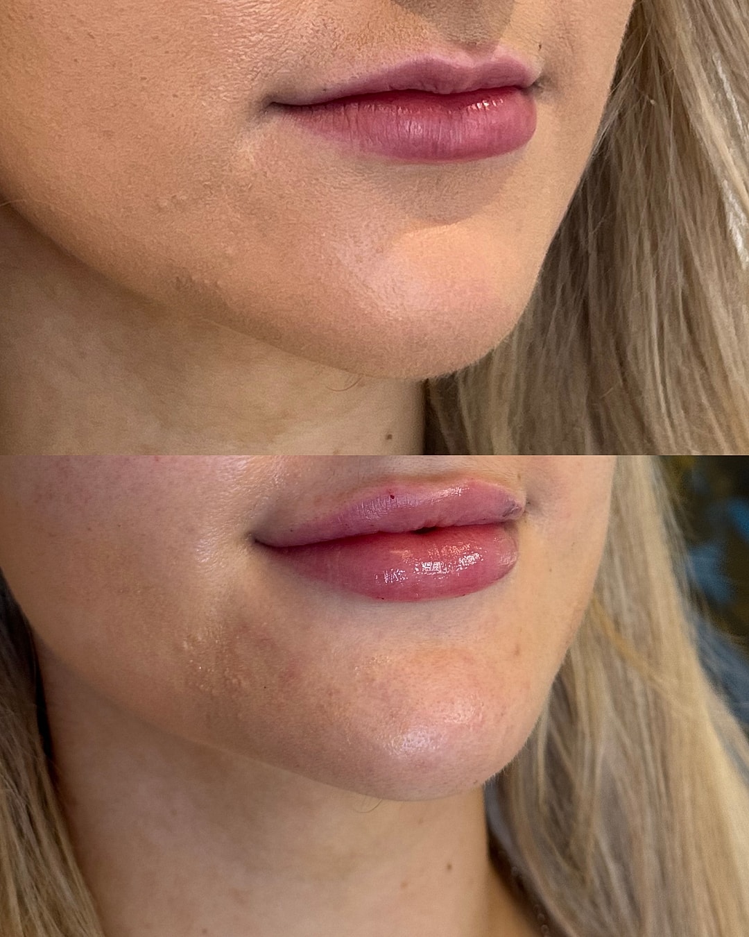 Lip Filler Before & After