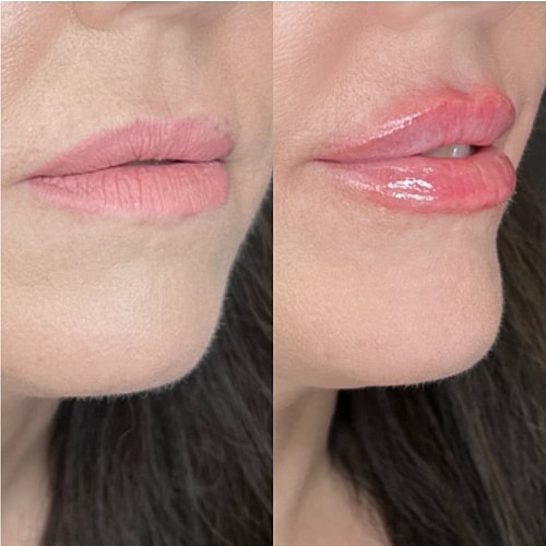 Lip Filler Before & After