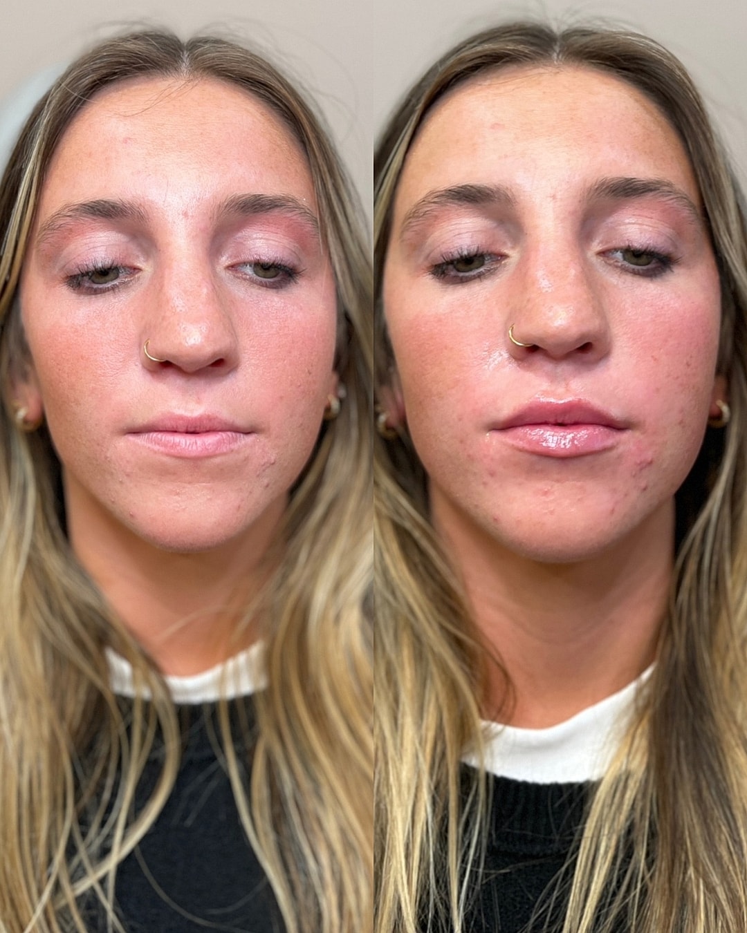 Lip Filler Before & After
