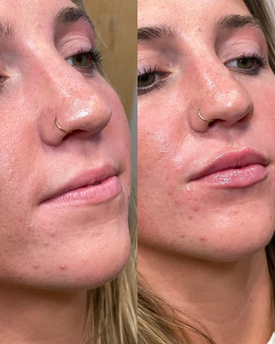 Lip Filler Before & After