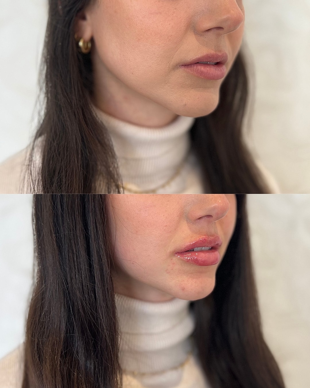 Lip Filler Before & After