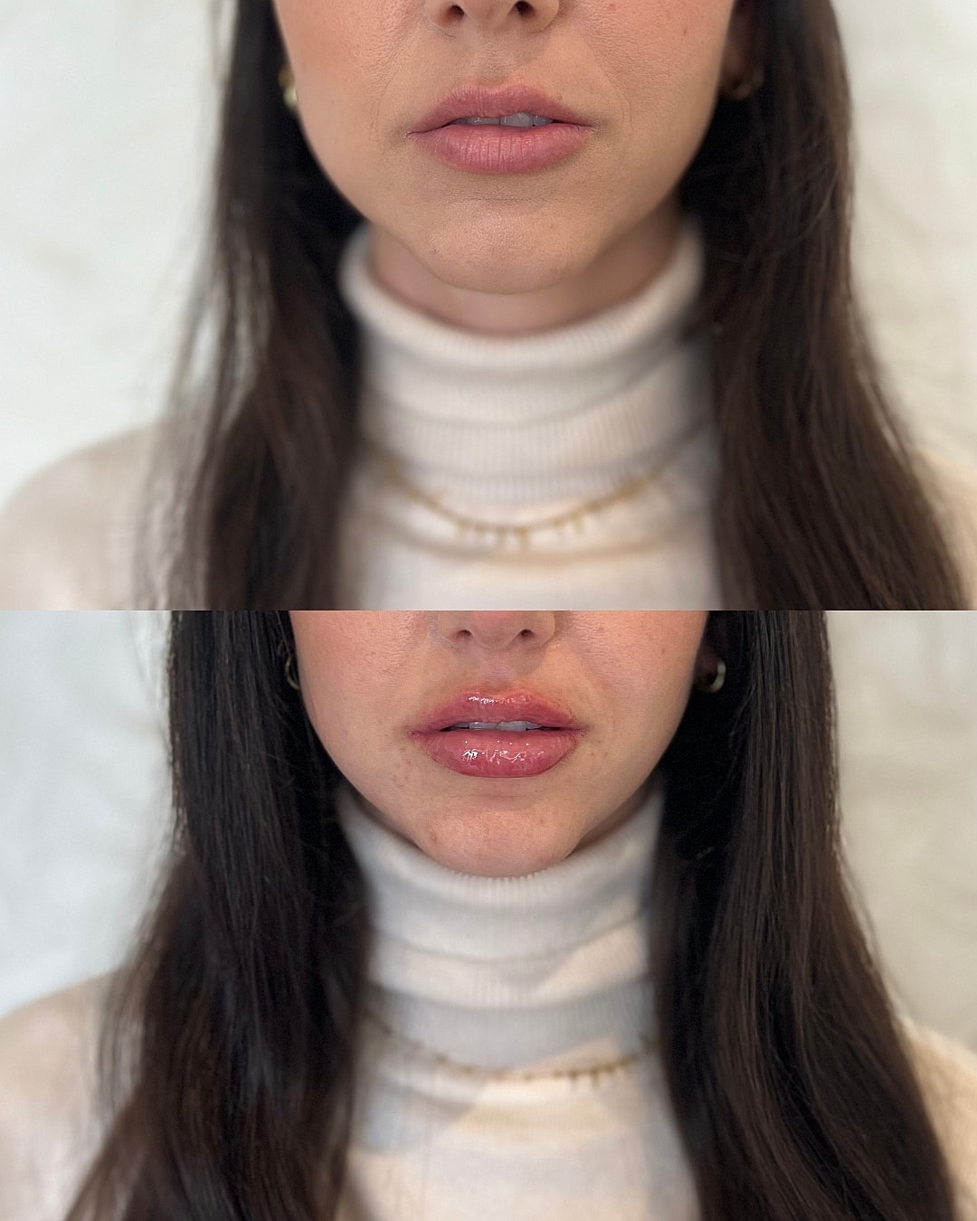 Lip Filler Before & After