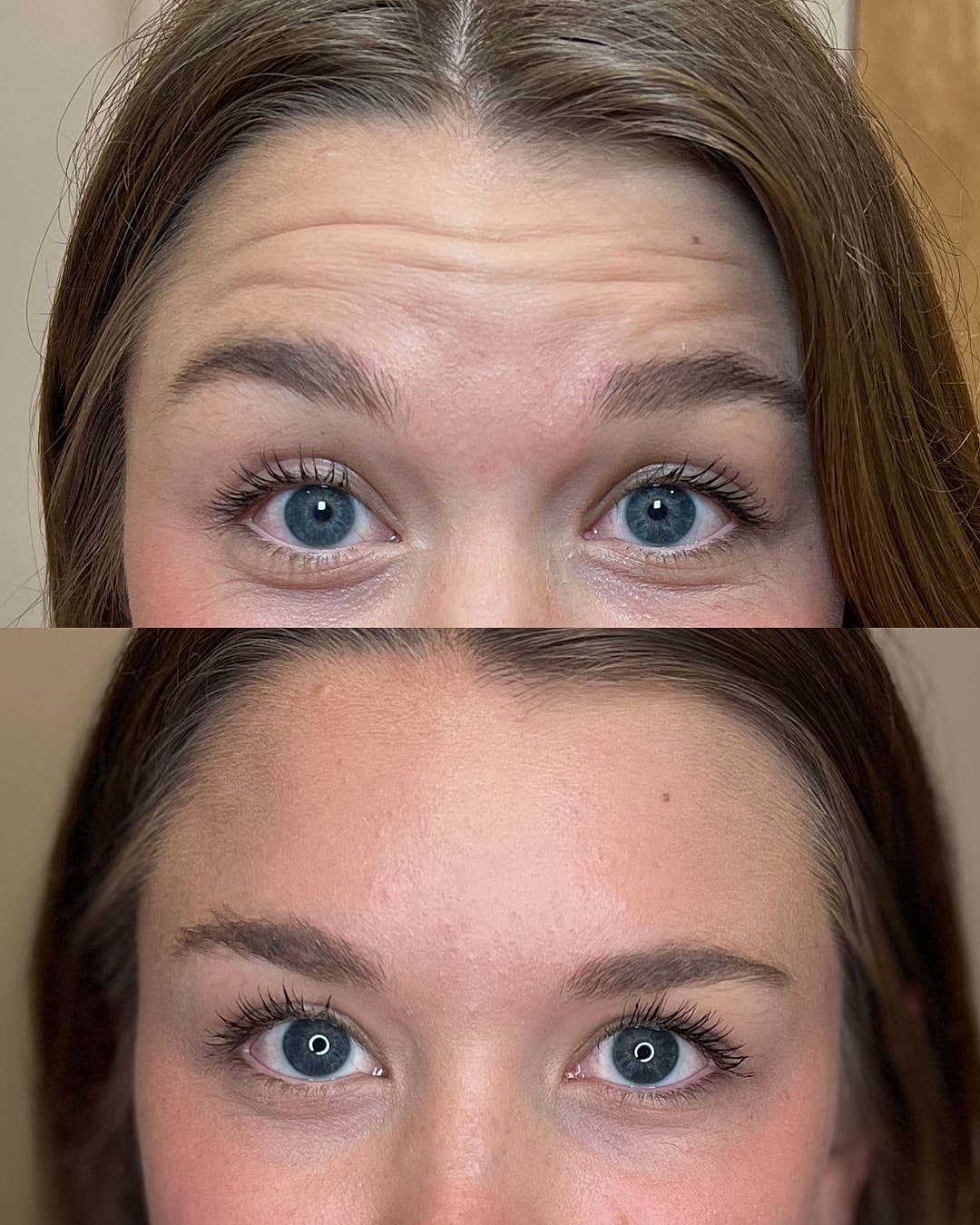 Botox Before & After