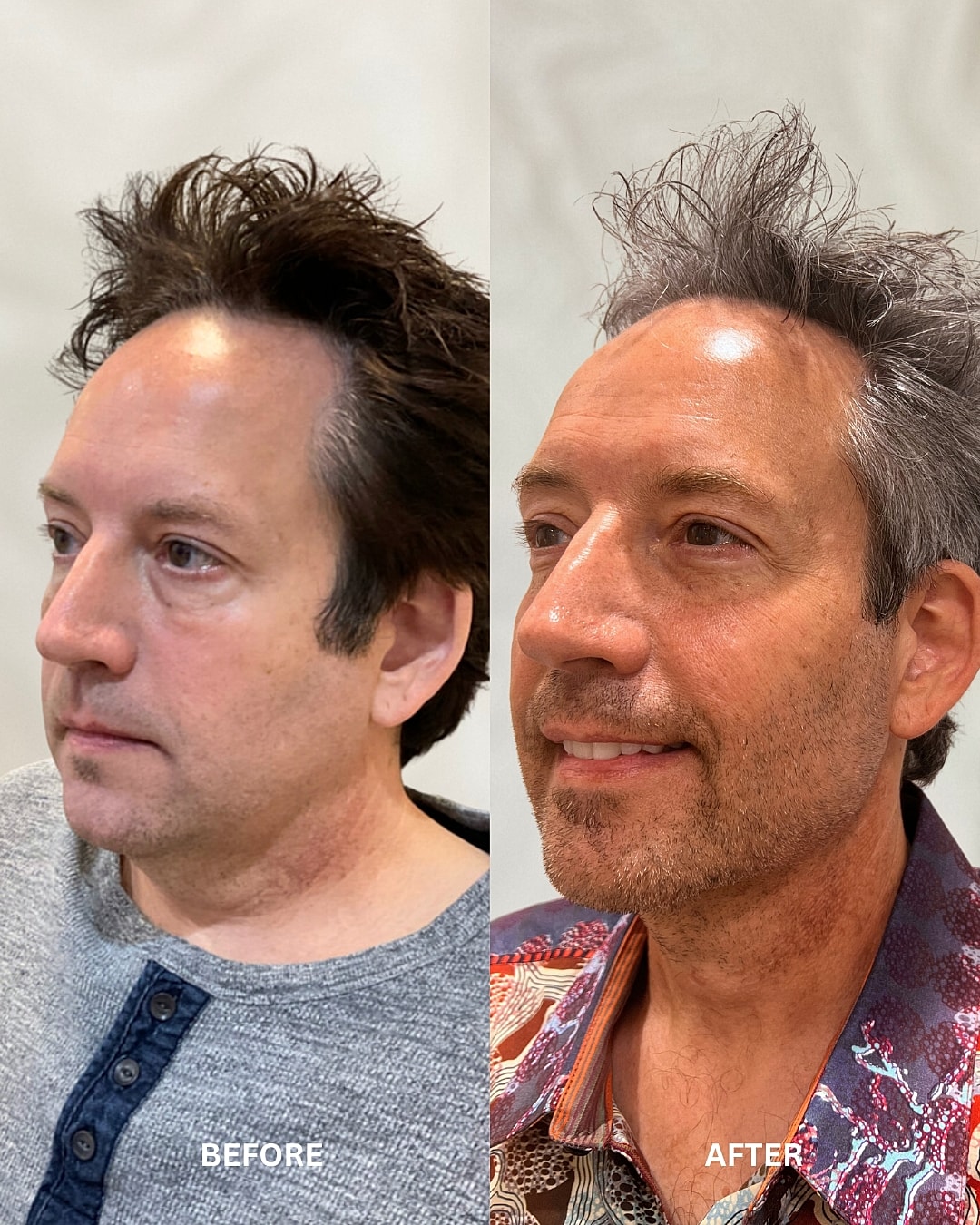 Weight Loss Injections Before & After