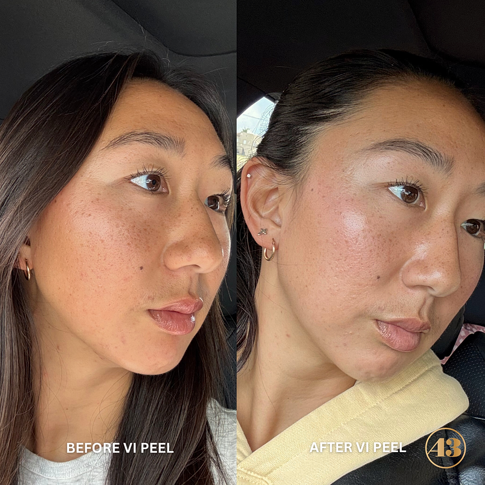 Vi Peel Before & After