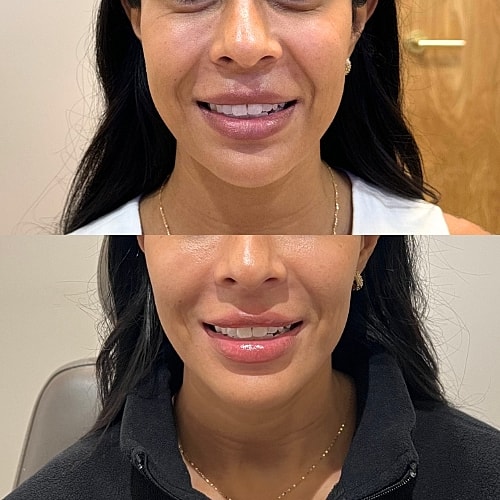 Masseter Botox Before & After