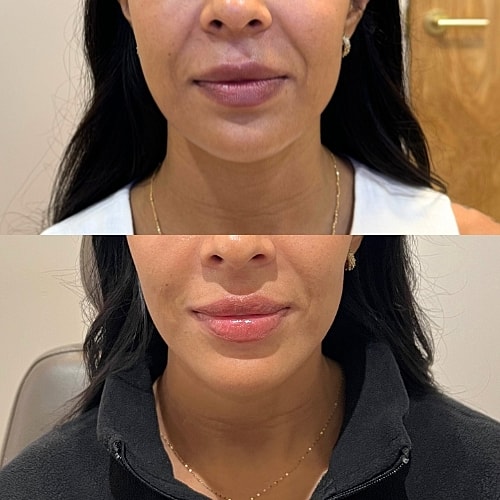 Masseter Botox Before & After
