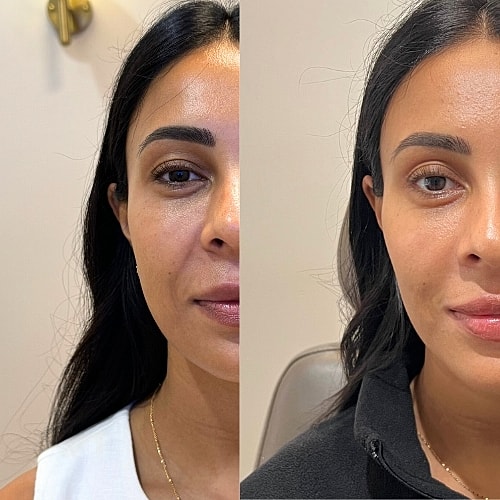 Masseter Botox Before & After