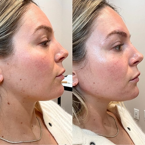 Jawline Filler Before & After