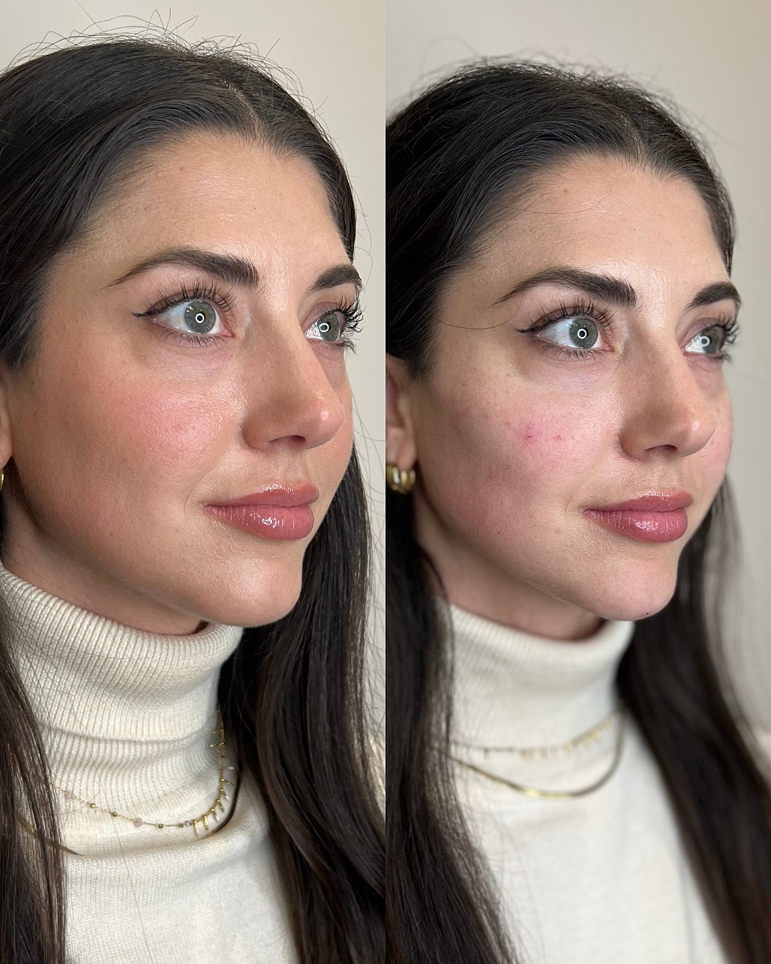 Dermal Fillers Before & After