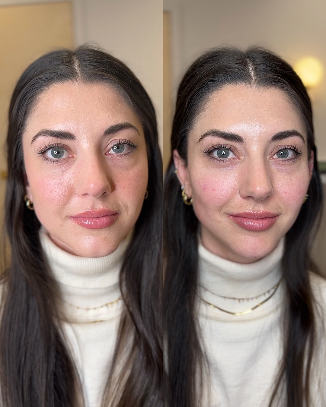 Dermal Fillers Before & After