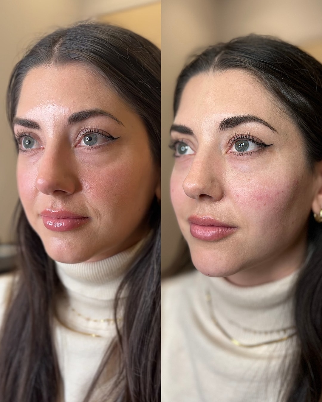 Dermal Fillers Before & After