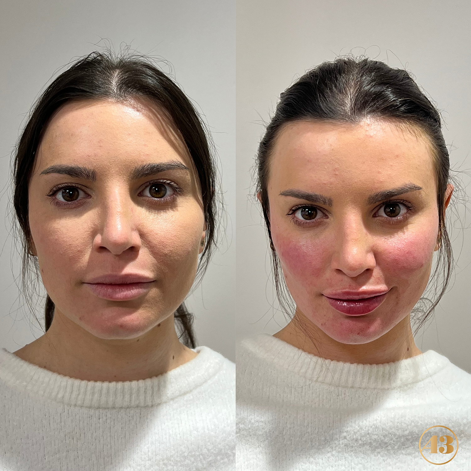 Facial Balancing Before & After