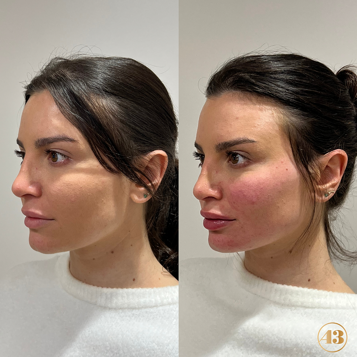 Facial Balancing Before & After