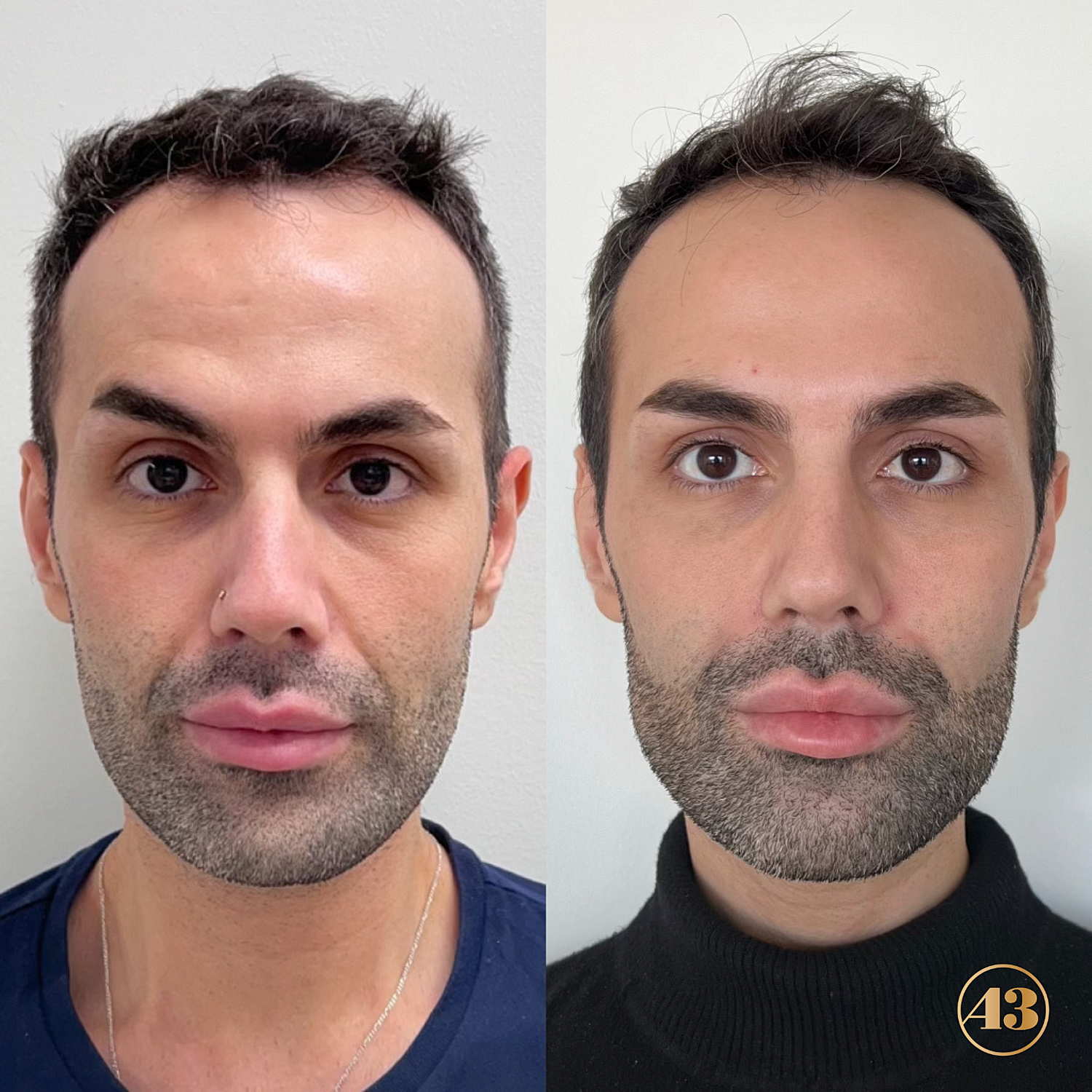 Facial Balancing Before & After